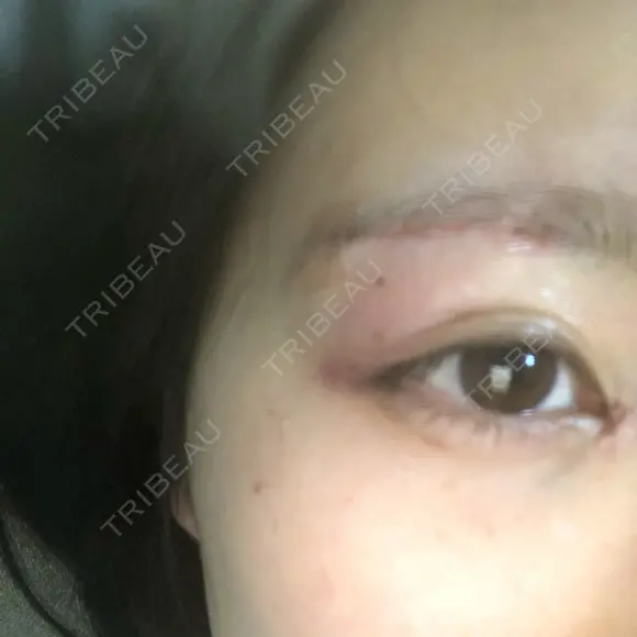 目頭切開 / 上まぶたたるみ取り 湘南美容クリニック 金沢院 DAY 2 メイン用