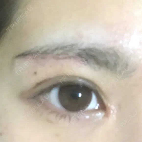 目頭切開 / 上まぶたたるみ取り 湘南美容クリニック 金沢院 DAY 7 メイン用