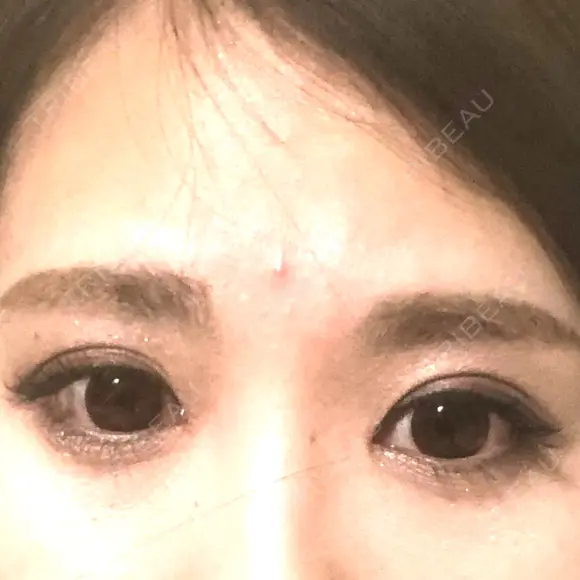 目頭切開 / 上まぶたたるみ取り 湘南美容クリニック 金沢院 AFTER メイン用