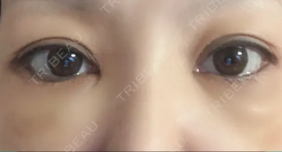 下まぶたたるみ取り セオリークリニック DAY 14 メイン用