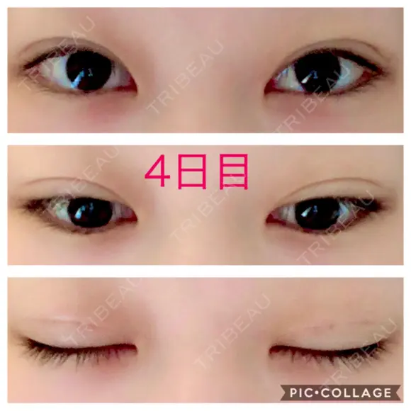 二重埋没 青山セレスクリニック 青山院 DAY 4 メイン用