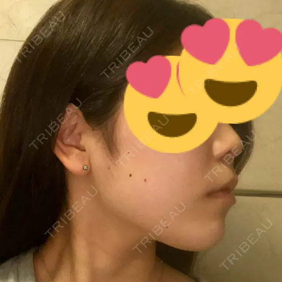 スレッドノーズ / ヒアルロン酸注入（鼻） / ヒアルロン酸注入（あご） / ヒアルロン酸注入（額） キップン整形外科 AFTER メイン用