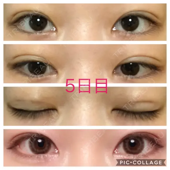 二重埋没 青山セレスクリニック 青山院 DAY 5 メイン用