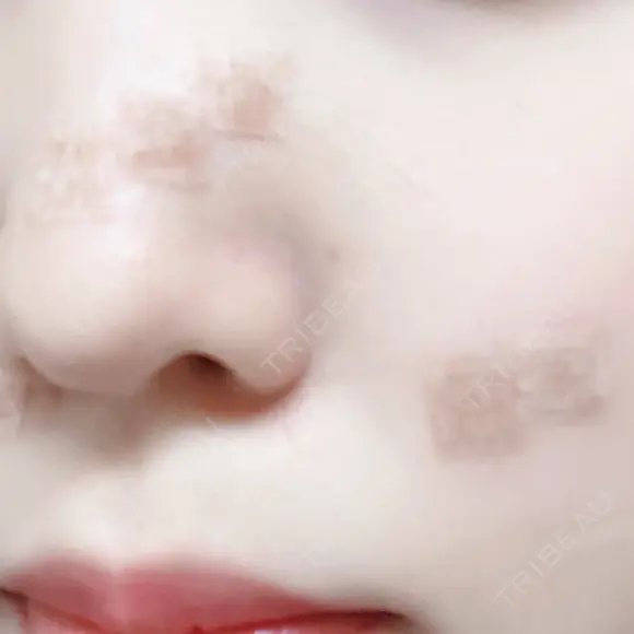 ほくろ・いぼ切除（肌） 赤坂メディカルMクリニック DAY 0 メイン用