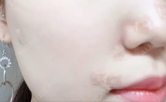 ほくろ・いぼ切除（肌） 赤坂メディカルMクリニック DAY 0 メイン用