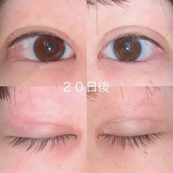 二重切開 / 上まぶたの脂肪取り 湘南美容クリニック 宇都宮院 DAY 20 メイン用