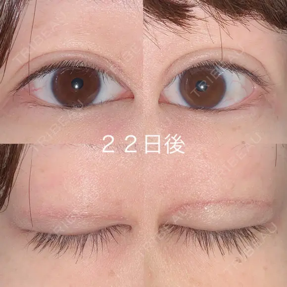 二重切開 / 上まぶたの脂肪取り 湘南美容クリニック 宇都宮院 DAY 22 メイン用