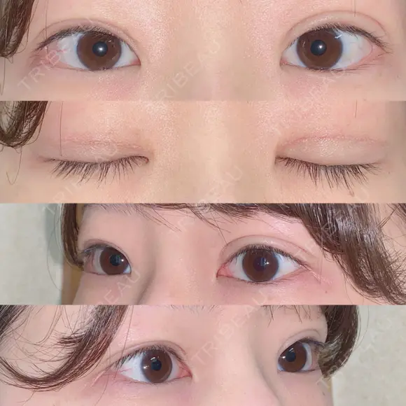 二重切開 / 上まぶたの脂肪取り 湘南美容クリニック 宇都宮院 DAY 22 メイン用