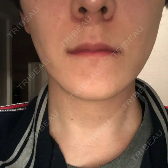 エレクトロポレーション 湘南美容クリニック 秋葉原院 DAY 2 メイン用