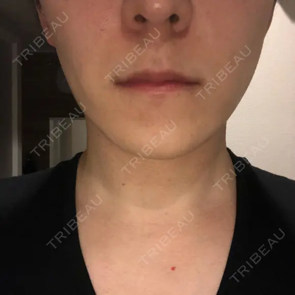 エレクトロポレーション 湘南美容クリニック 秋葉原院 DAY 3 メイン用