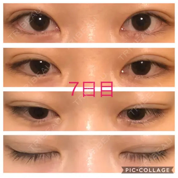 二重埋没 青山セレスクリニック 青山院 DAY 7 メイン用