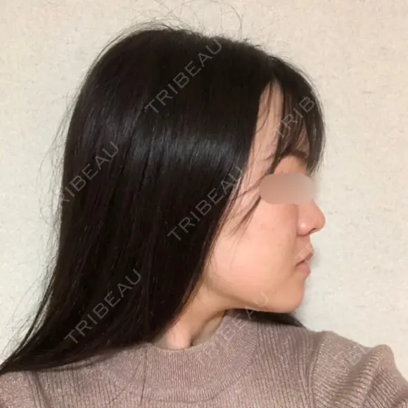 骨切り（あご） / 骨削り（エラ） / 骨削り（頬） RG整形外科（旧リオン整形外科） DAY 122 メイン用