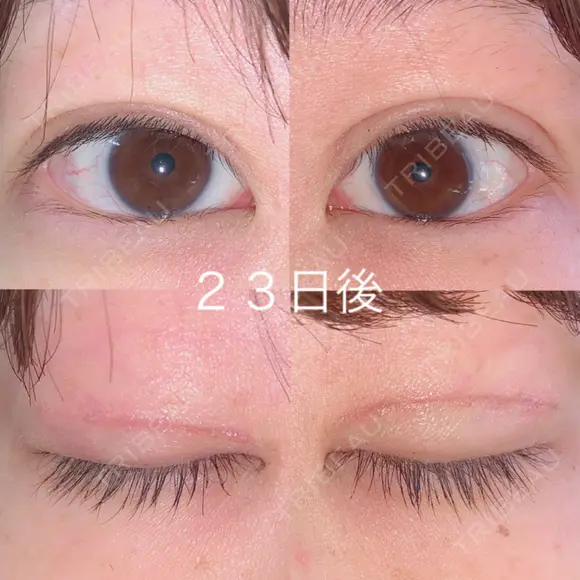 二重切開 / 上まぶたの脂肪取り 湘南美容クリニック 宇都宮院 DAY 23 メイン用