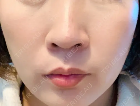 イオン導入 / 美肌レーザー / シミ取りレーザー / フォトRF / YAGレーザー / ニキビ治療 お肌のクリニック　高田馬場 DAY 29 メイン用