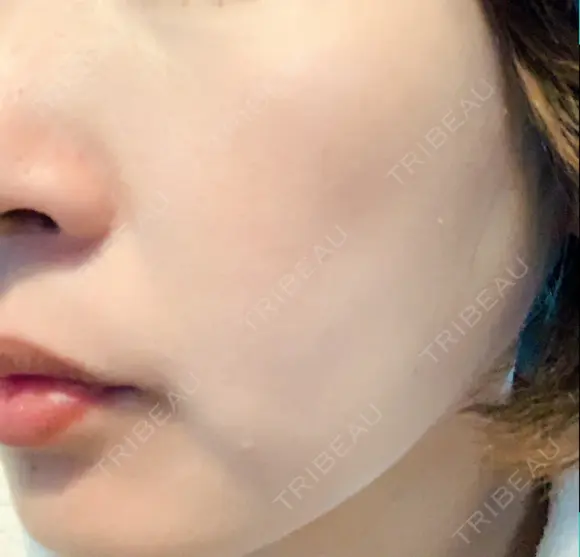 イオン導入 / 美肌レーザー / シミ取りレーザー / フォトRF / YAGレーザー / ニキビ治療 お肌のクリニック　高田馬場 DAY 29 メイン用