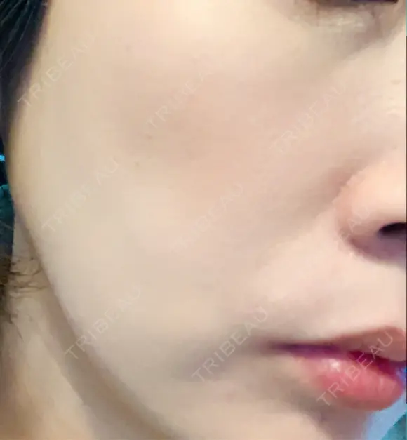 イオン導入 / 美肌レーザー / シミ取りレーザー / フォトRF / YAGレーザー / ニキビ治療 お肌のクリニック　高田馬場 DAY 29 メイン用