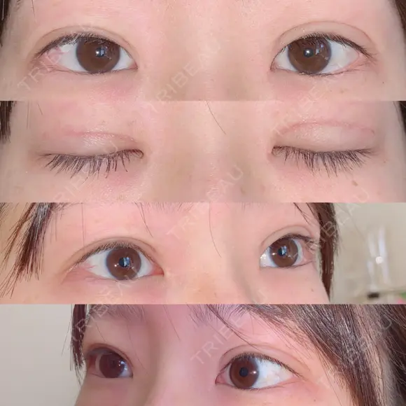 二重切開 / 上まぶたの脂肪取り 湘南美容クリニック 宇都宮院 DAY 24 メイン用