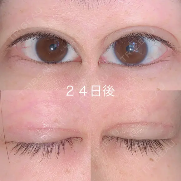 二重切開 / 上まぶたの脂肪取り 湘南美容クリニック 宇都宮院 DAY 24 メイン用
