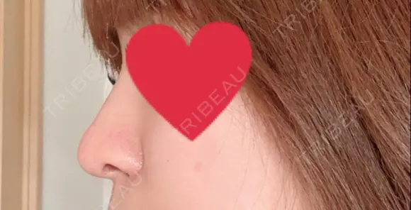 隆鼻術 / 鼻尖形成（切開） / 軟骨移植 湘南美容クリニック 名古屋栄院 DAY 31 メイン用