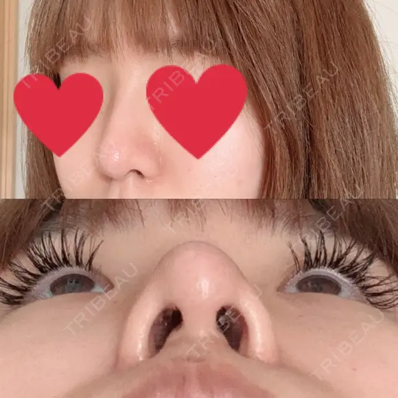 隆鼻術 / 鼻尖形成（切開） / 軟骨移植 湘南美容クリニック 名古屋栄院 DAY 31 メイン用