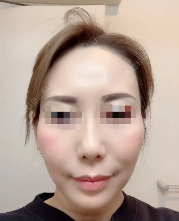 その他（目元） / クマ治療 / 額を丸く / その他（輪郭） / 下まぶたの脂肪取り / 脂肪注入（肌） / こめかみ形成 / 脂肪注入（額） / ヒアルロン酸注入（涙袋） / 脂肪注入（輪郭） / PRP皮膚再生療法 ジュエリー美容外科 DAY 28 メイン用