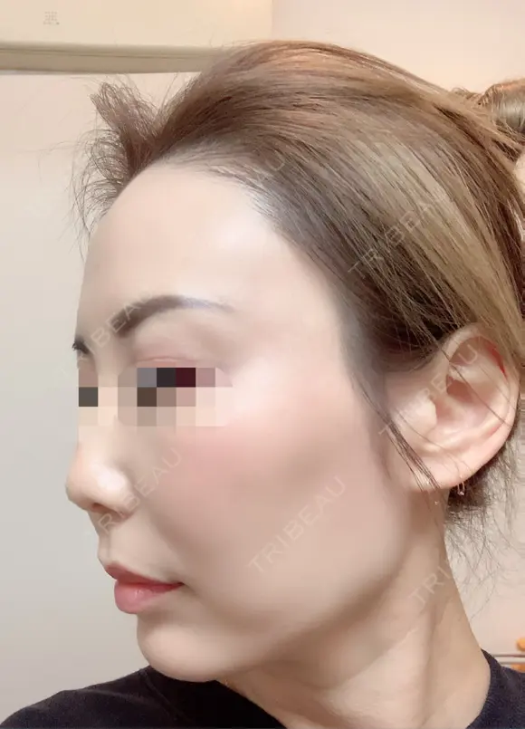 その他（目元） / クマ治療 / 額を丸く / その他（輪郭） / 下まぶたの脂肪取り / 脂肪注入（肌） / こめかみ形成 / 脂肪注入（額） / ヒアルロン酸注入（涙袋） / 脂肪注入（輪郭） / PRP皮膚再生療法 ジュエリー美容外科 DAY 28 メイン用