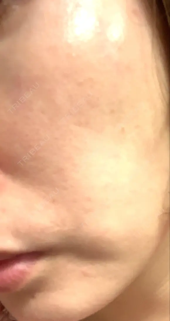 イオン導入 / 美肌レーザー / シミ取りレーザー / フォトRF / YAGレーザー / ニキビ治療 お肌のクリニック　高田馬場 DAY 29 メイン用