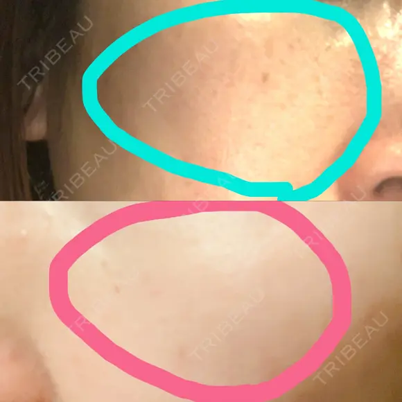 イオン導入 / 美肌レーザー / シミ取りレーザー / フォトRF / YAGレーザー / ニキビ治療 お肌のクリニック　高田馬場 DAY 29 メイン用