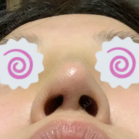鼻修正 たにまちクリニック DAY 8 メイン用