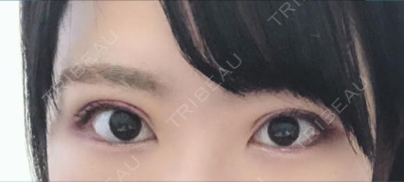 二重埋没 湘南美容クリニック 京都院 AFTER メイン用