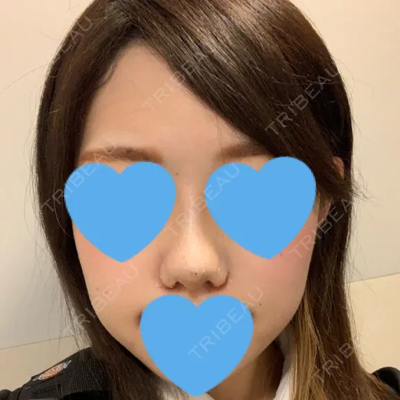 小鼻縮小（切開） / スレッドノーズ / ヒアルロン酸注入（鼻） キップン整形外科 DAY 7 メイン用