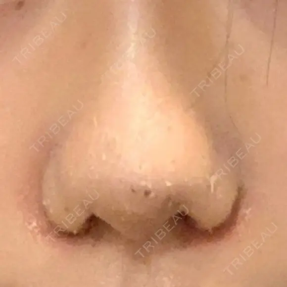 小鼻縮小（切開） / スレッドノーズ / ヒアルロン酸注入（鼻） キップン整形外科 DAY 7 メイン用