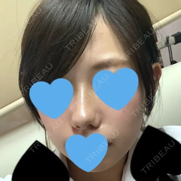 小鼻縮小（切開） / スレッドノーズ / ヒアルロン酸注入（鼻） キップン整形外科 DAY 8 メイン用