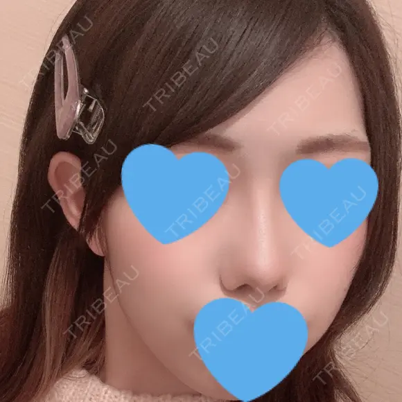 小鼻縮小（切開） / スレッドノーズ / ヒアルロン酸注入（鼻） キップン整形外科 DAY 32 メイン用