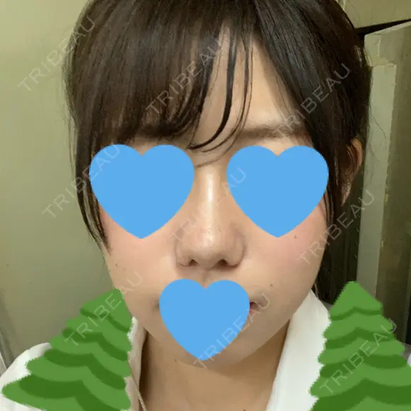 小鼻縮小（切開） / スレッドノーズ / ヒアルロン酸注入（鼻） キップン整形外科 DAY 11 メイン用