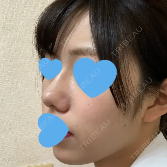 小鼻縮小（切開） / スレッドノーズ / ヒアルロン酸注入（鼻） キップン整形外科 DAY 11 メイン用