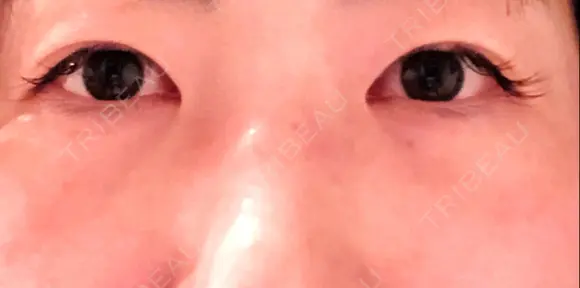 下まぶたの脂肪取り 品川美容外科 渋谷院（※品川スキンクリニック提携） DAY 8 メイン用