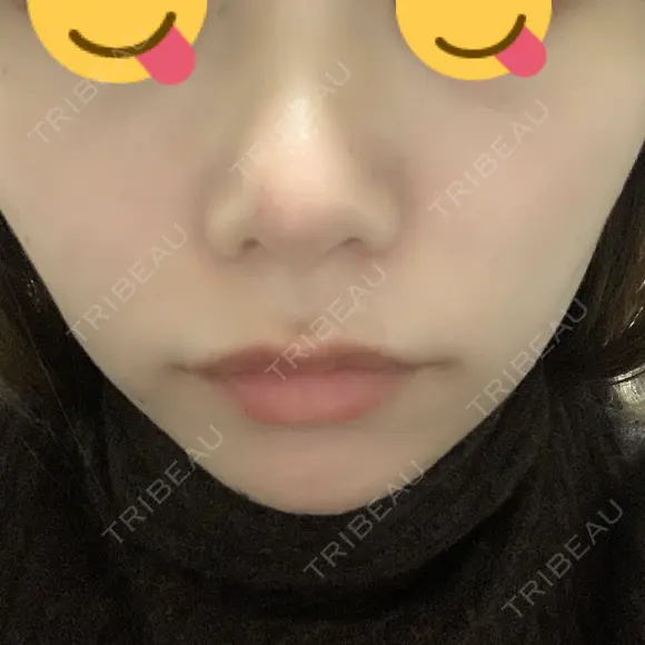 鼻尖形成（切開） / 鼻中隔延長（切開） / 小鼻縮小（切開） / 軟骨移植 HANABI整形外科 AFTER メイン用