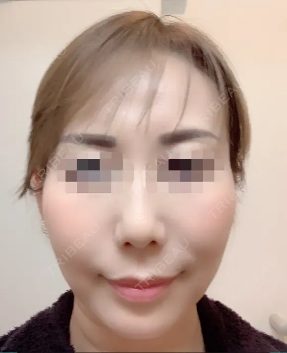 その他（目元） / クマ治療 / 額を丸く / その他（輪郭） / 下まぶたの脂肪取り / 脂肪注入（肌） / こめかみ形成 / 脂肪注入（額） / ヒアルロン酸注入（涙袋） / 脂肪注入（輪郭） / PRP皮膚再生療法 ジュエリー美容外科 DAY 31 メイン用