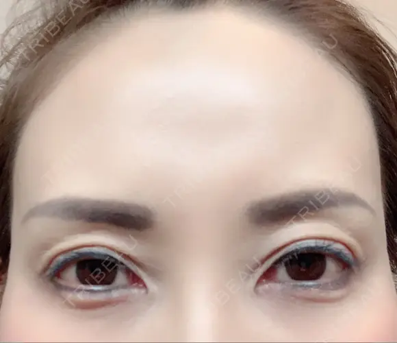 その他（目元） / クマ治療 / 額を丸く / その他（輪郭） / 下まぶたの脂肪取り / 脂肪注入（肌） / こめかみ形成 / 脂肪注入（額） / ヒアルロン酸注入（涙袋） / 脂肪注入（輪郭） / PRP皮膚再生療法 ジュエリー美容外科 DAY 31 メイン用