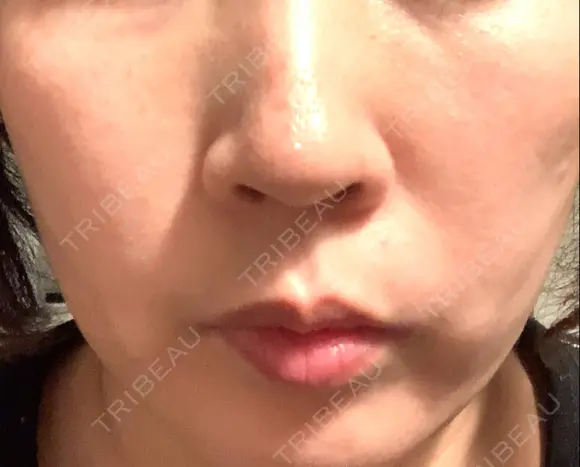 イオン導入 / 美肌レーザー / シミ取りレーザー / フォトRF / YAGレーザー / ニキビ治療 お肌のクリニック　高田馬場 DAY 32 メイン用