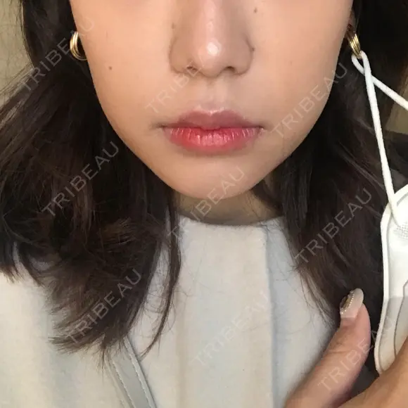 脂肪溶解注射（顔） / 美容点滴・美容注射（美肌） / ボトックス（肩） / ハイフ（顔） リエンジャン整形外科 江南店 DAY 1 メイン用