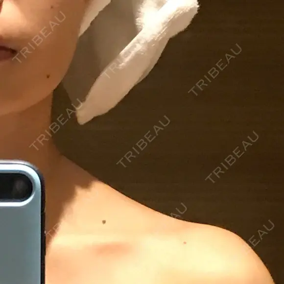 脂肪溶解注射（顔） / 美容点滴・美容注射（美肌） / ボトックス（肩） / ハイフ（顔） リエンジャン整形外科 江南店 DAY 1 メイン用