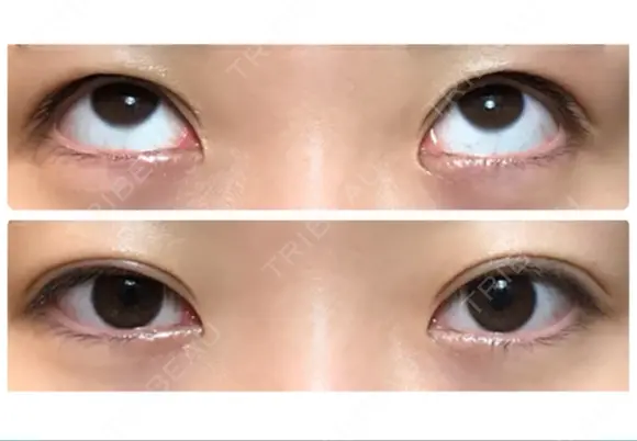 二重切開 / 上まぶたたるみ取り / 上まぶたの脂肪取り / 目元修正 リビジョンクリニック（旧：池本形成外科・美容外科） DAY 62 メイン用