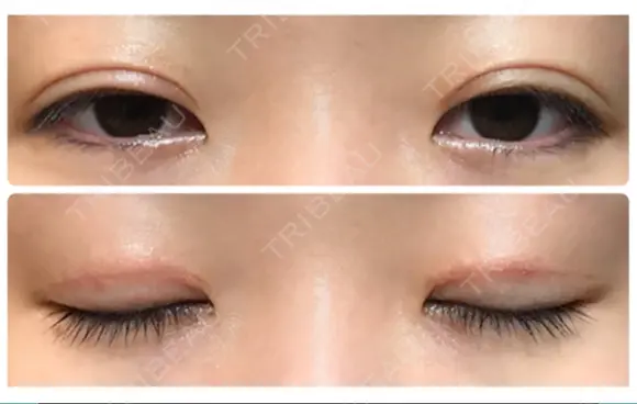 二重切開 / 上まぶたたるみ取り / 上まぶたの脂肪取り / 目元修正 リビジョンクリニック（旧：池本形成外科・美容外科） DAY 62 メイン用