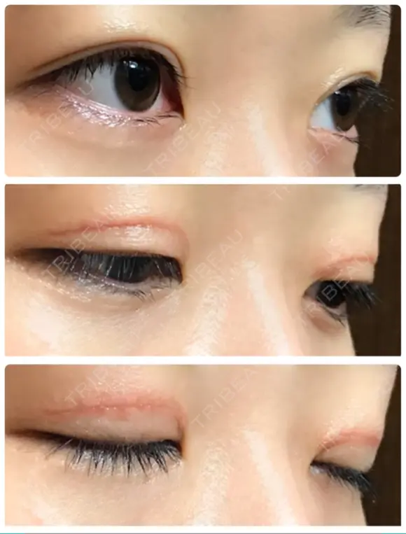 二重切開 / 上まぶたたるみ取り / 上まぶたの脂肪取り / 目元修正 リビジョンクリニック（旧：池本形成外科・美容外科） DAY 62 メイン用