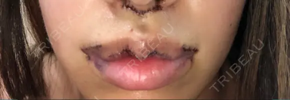 人中短縮 / 口角挙上 / その他（口元） 清潭女神美容外科 DAY 2 メイン用