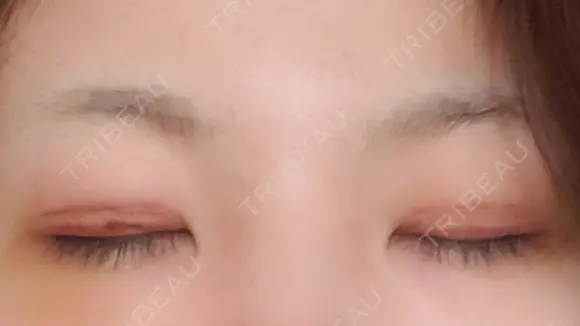 二重切開 / 上まぶたの脂肪取り 湘南美容クリニック 宇都宮院 DAY 8 メイン用