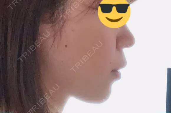 ボトックス（あご） / ヒアルロン酸注入（あご） / その他（輪郭） 品川美容外科 仙台院 DAY 2 メイン用