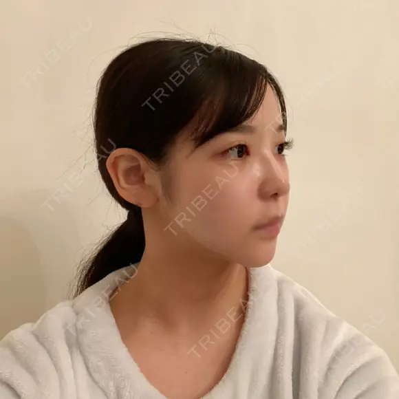 骨削り（頬） / 脂肪吸引（顔） / ボトックス（エラ・小顔） / ボトックス（ふくらはぎ） / ヒアルロン酸注入（額） / ボトックス（肩） RG整形外科（旧リオン整形外科） DAY 22 メイン用